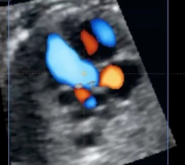 Corazón fetal: adquisición STIC con Doppler color en Fetal Visor