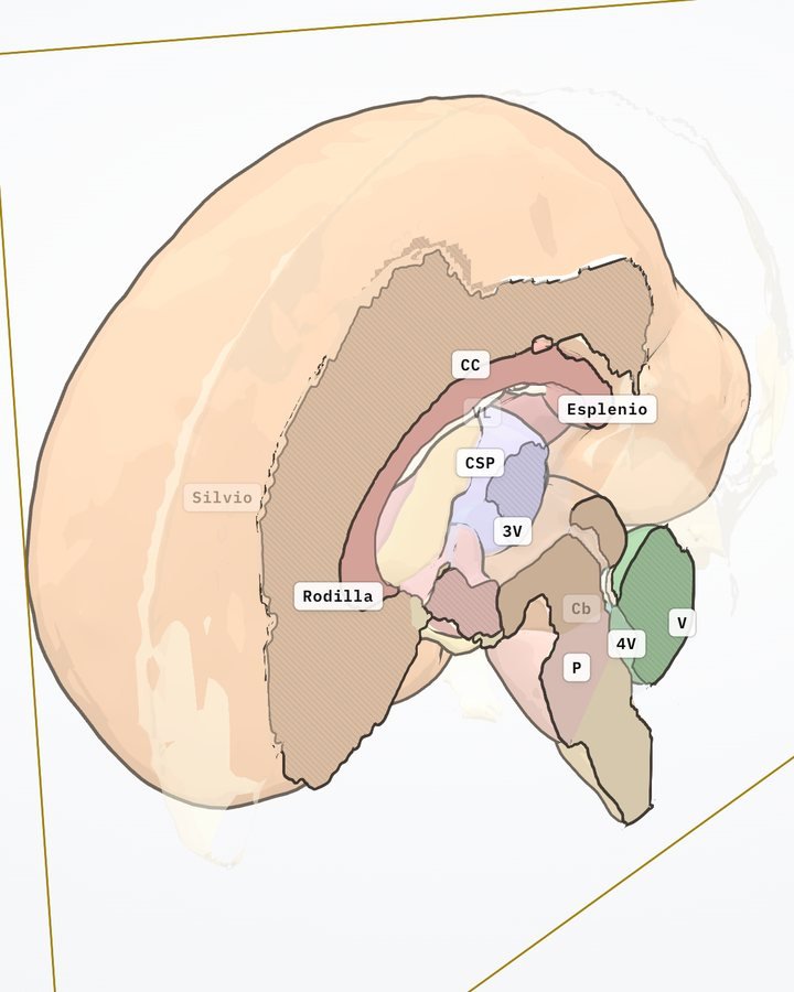 Corte sagital medio: cuerpo calloso, cavum, tercer y cuarto ventrículos y vermis