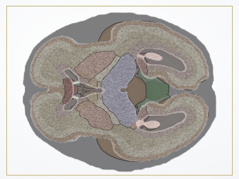 Axial transtalámico en la eco simulada de Fetal Brain 3D