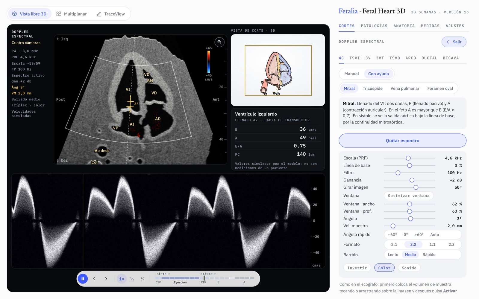Doppler espectral del llenado mitral en Fetal Heart 3D: ondas E y A con sus mediciones