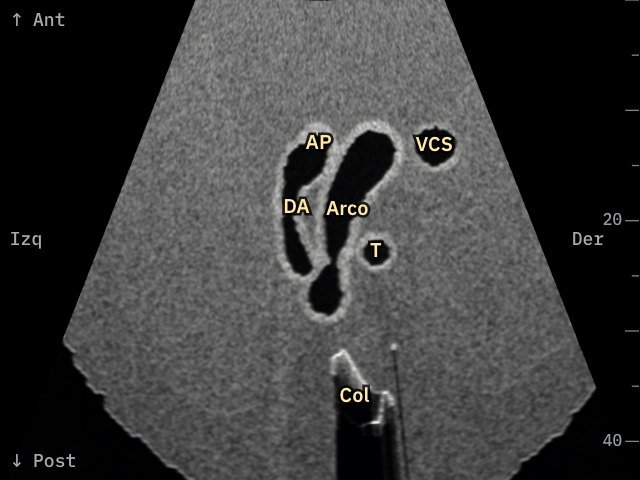 Tres vasos y tráquea · Fallot · eco simulada de Fetal Heart 3D