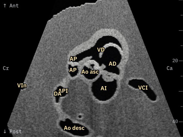 Eje corto del tracto de salida derecho · Fallot · eco simulada de Fetal Heart 3D