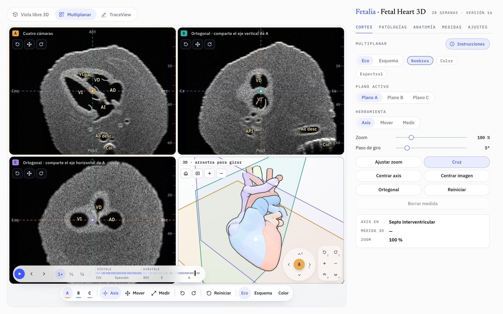Modo Multiplanar de Fetal Heart 3D: planos A, B y C y la vista 3D con los tres planos