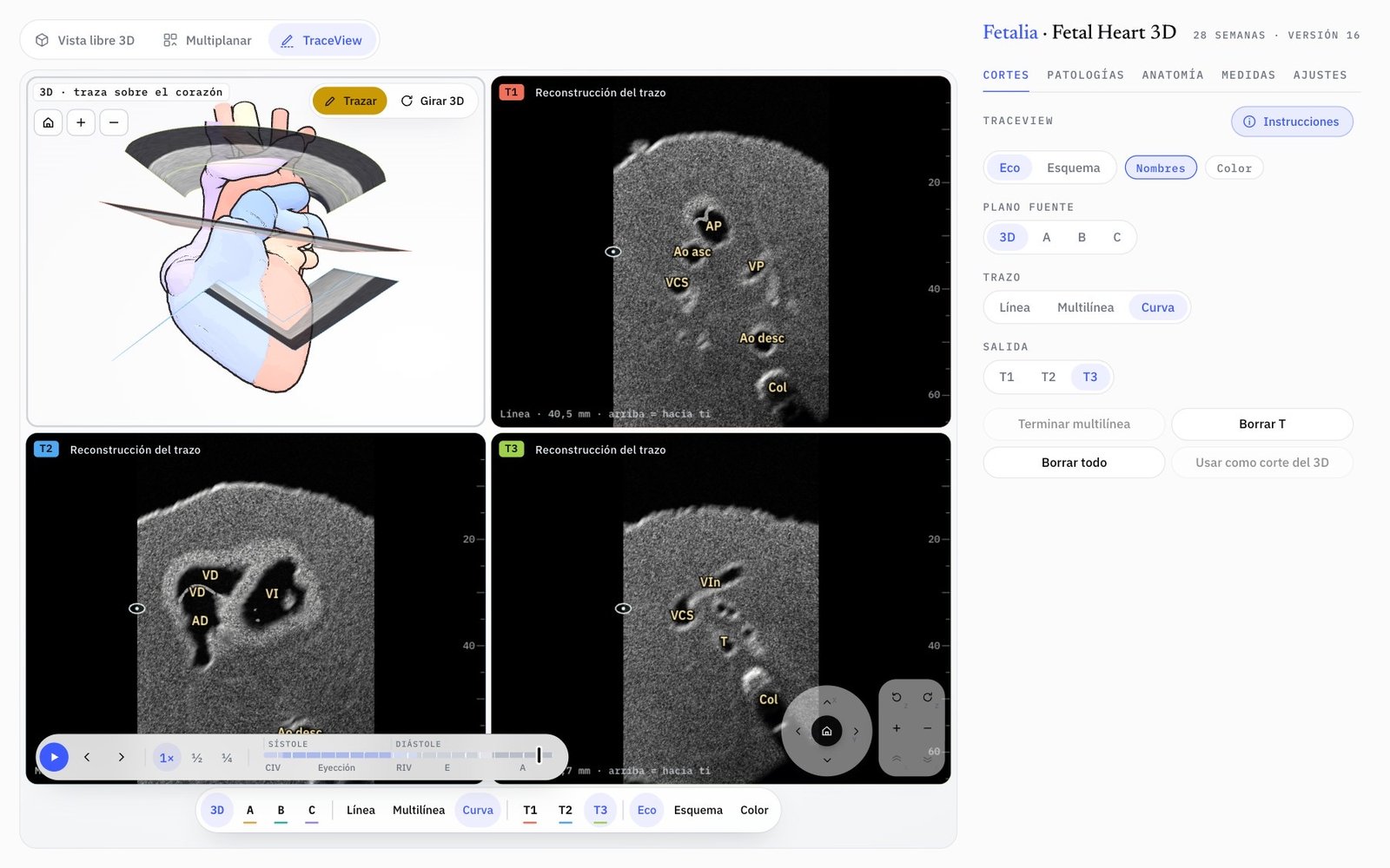 Modo TraceView de Fetal Heart 3D: tres trazos sobre el corazón 3D y sus reconstrucciones T1, T2 y T3
