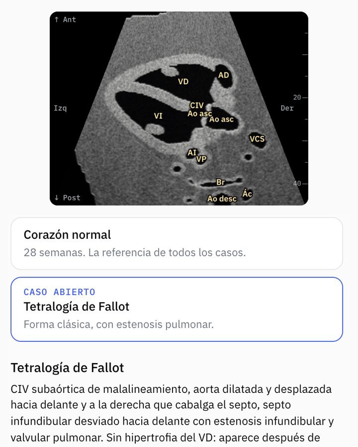 Pestaña Patologías de Fetal Heart 3D: la eco de la Fallot y la lista de casos