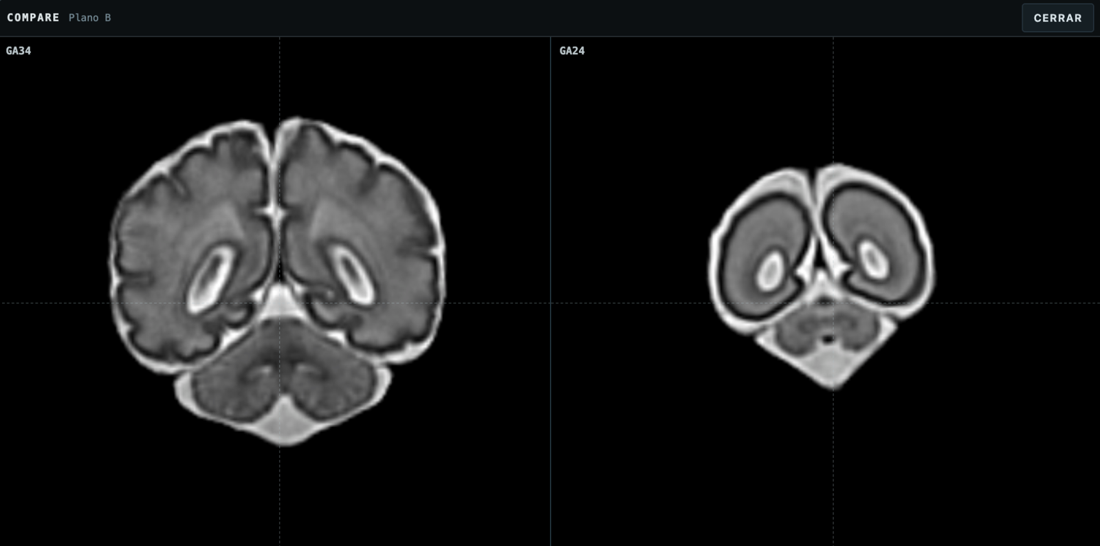 Comparación gestacional en la interfaz de Fetal NeuroAtlas