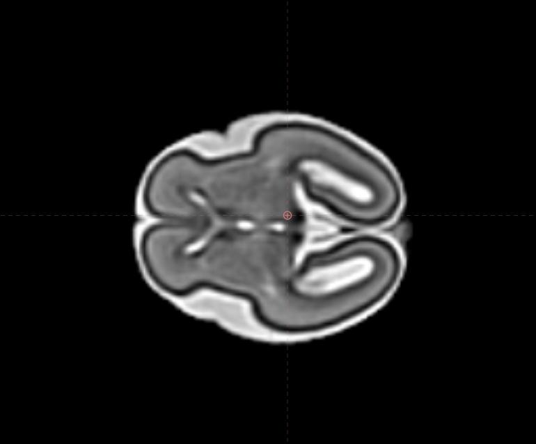 Cortes del cerebro fetal a las 24 semanas en Fetalia NeuroAtlas