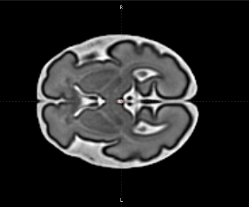 Cortes del cerebro fetal a las 31 semanas en Fetalia NeuroAtlas