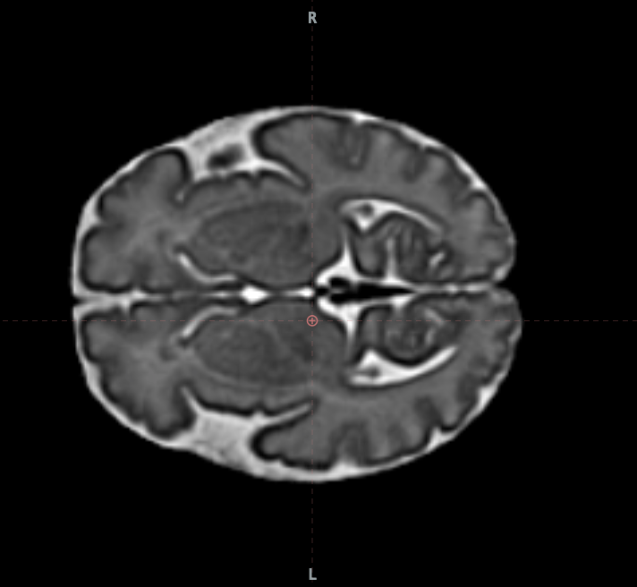 Cortes del cerebro fetal a las 37 semanas en Fetalia NeuroAtlas