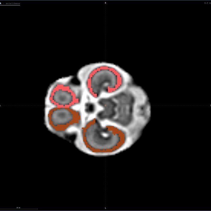 Placa cortical a las 21 semanas en Fetalia NeuroAtlas