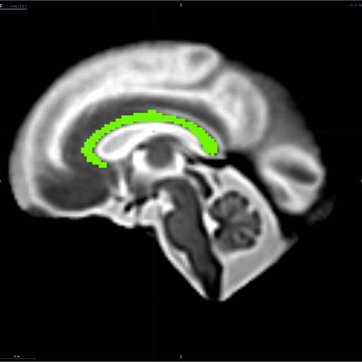 Corte sagital medio de NeuroAtlas con el cuerpo calloso seleccionado