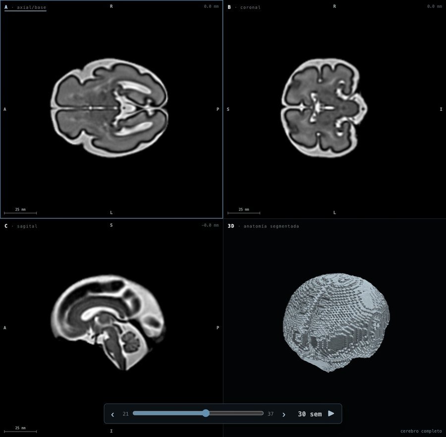 Capa MRI · T2 a las 30 semanas en Fetalia NeuroAtlas: axial, coronal, sagital y 3D