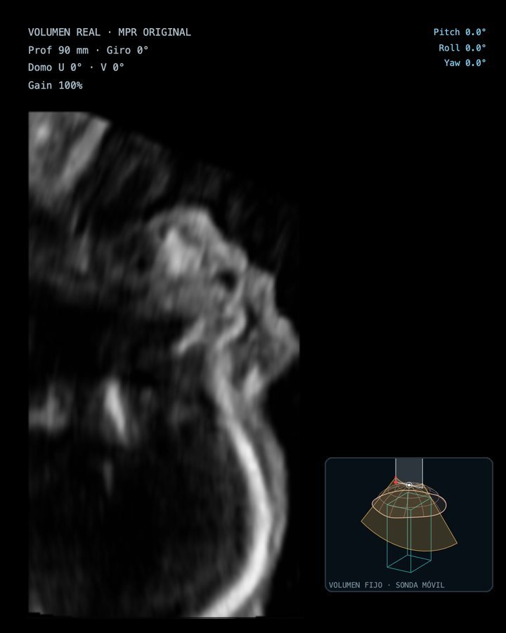 Volumen FVOL de cabeza y cara: perfil fetal