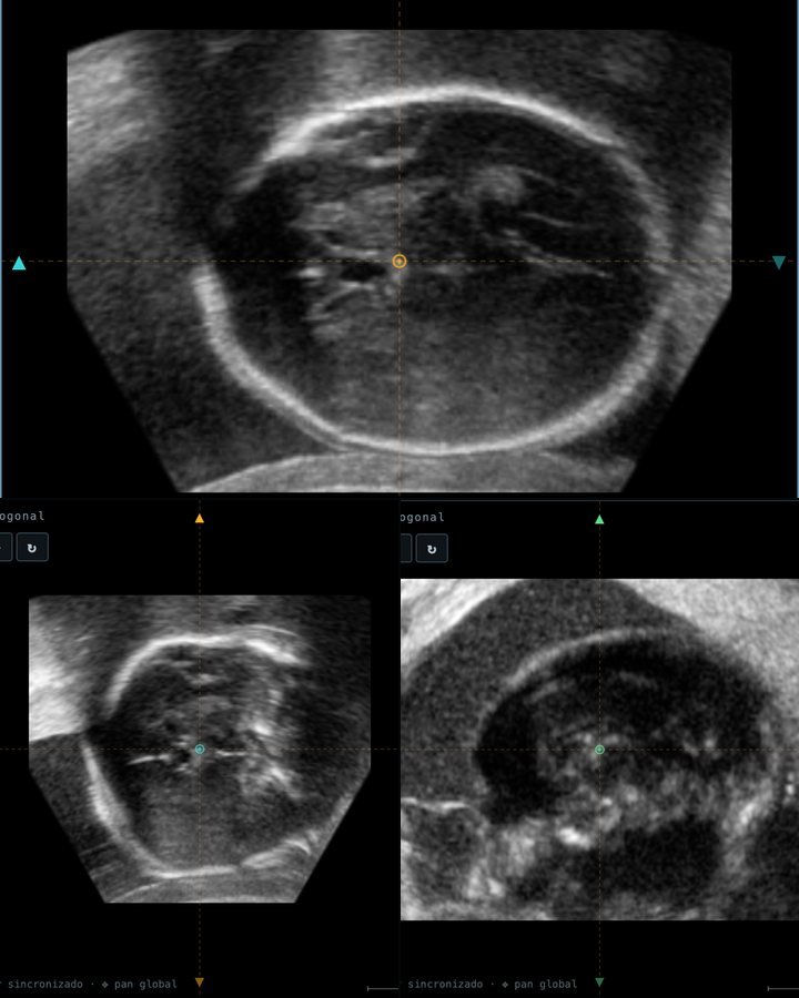 Volumen 3D del cerebro fetal en los planos A, B y C
