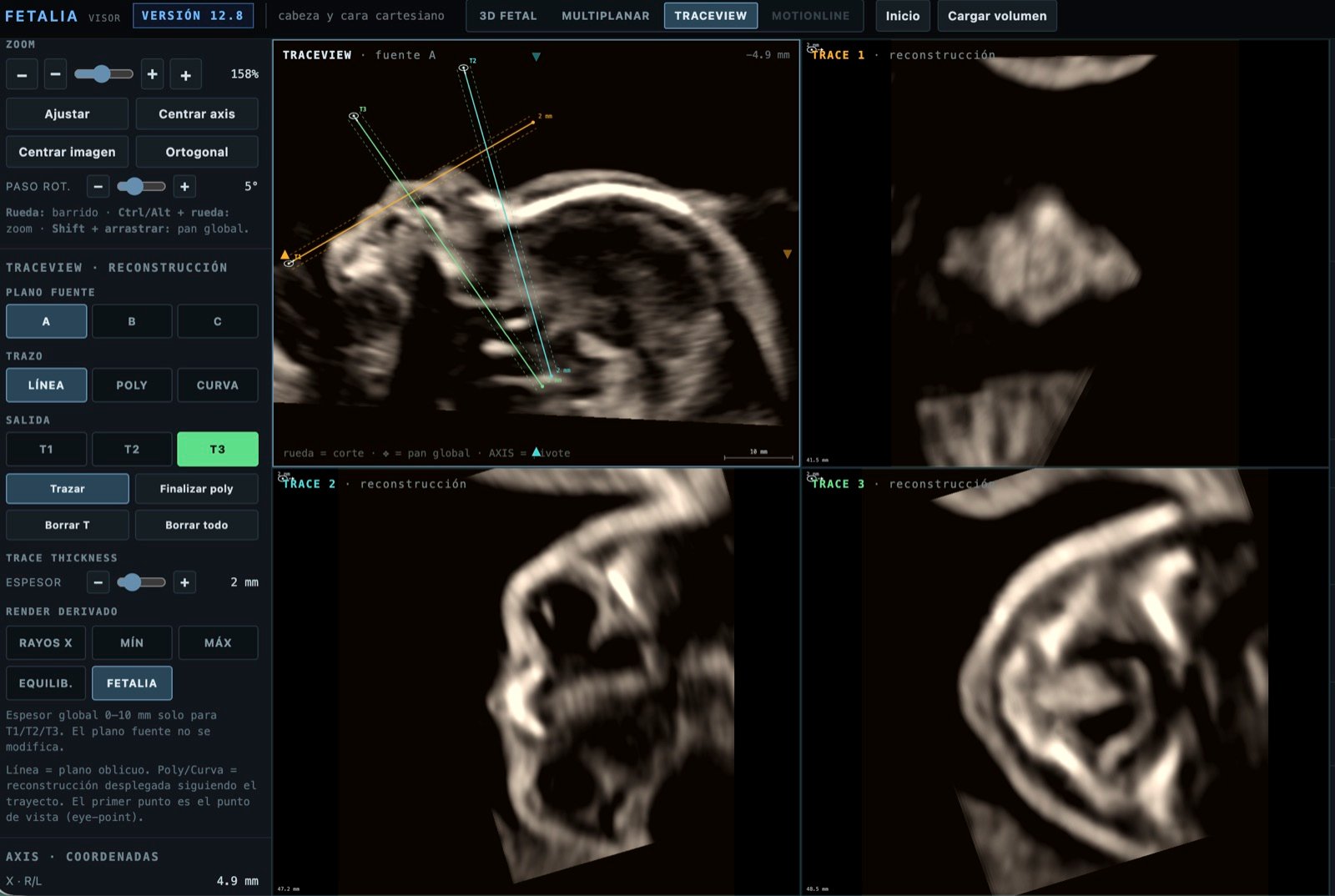 TraceView sobre la cara fetal: tres trazos en el plano fuente y sus reconstrucciones T1, T2 y T3